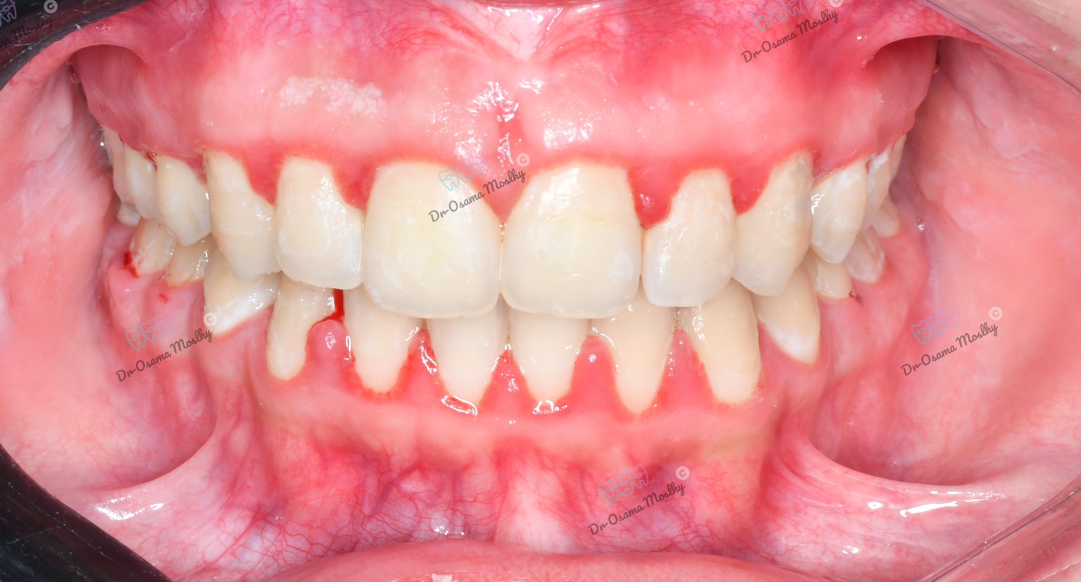 بعد علاج فلجة الأسنان العلوية (Midline Diastema) — أمامي