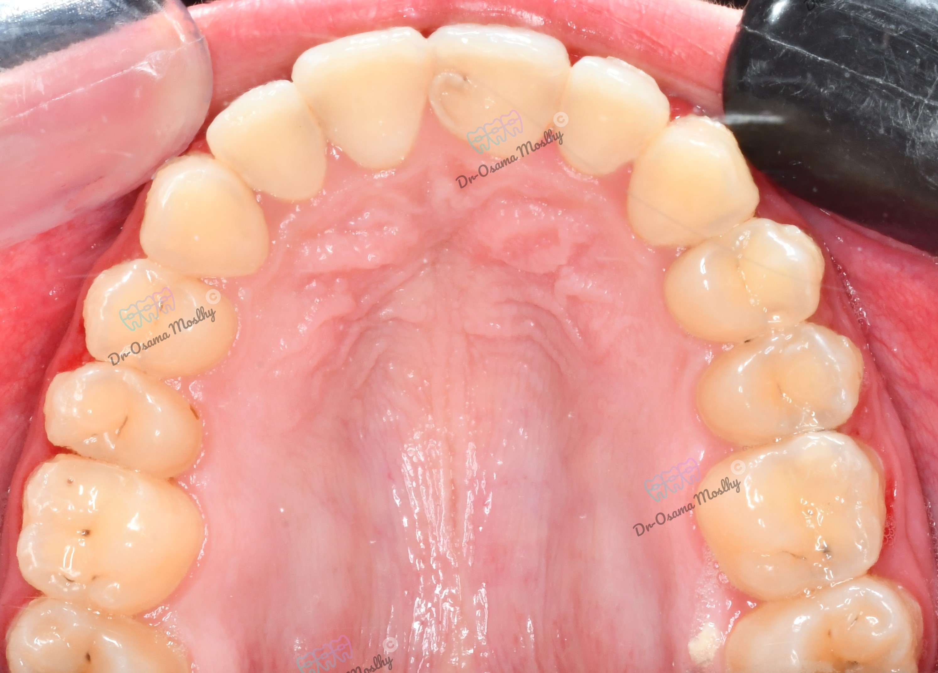 بعد علاج فلجة الأسنان العلوية (Midline Diastema) — علوي