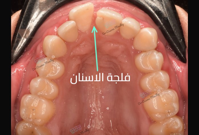 قبل علاج فلجة الأسنان العلوية (Midline Diastema) — علوي