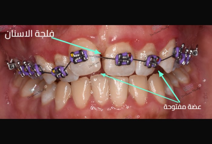 قبل علاج فلجة الأسنان العلوية (Midline Diastema) — أمامي