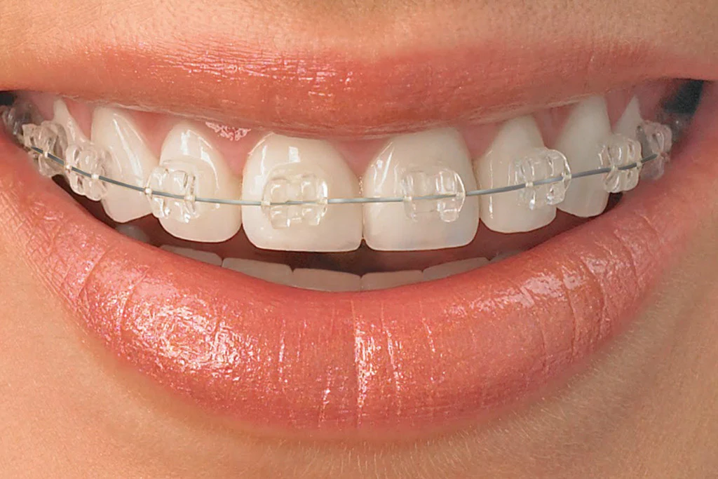 التقويم الأبيض ( Ceramic Braces)